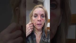 Skin Cancer Fluorouracil Topical treatment Day 17 [upl. by Marlin]