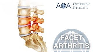 AOA Orthopedic Specialists  Facet Arthritis [upl. by Meelas]