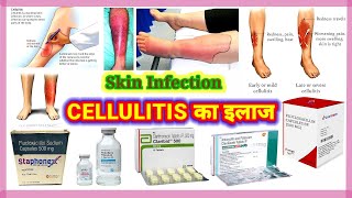 5 Effective and Easy Home Remedies for Cellulitis [upl. by Kippar]