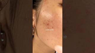 CYSTIC ACNE TREATMENT 2 weeks✨ [upl. by Gervais]