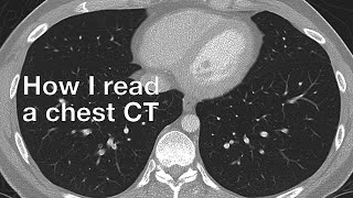 How I Read a Chest CT [upl. by Hippel]