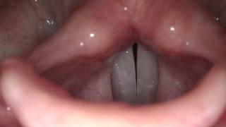 Stroboscopy Normal Female Vocal Cords [upl. by Lucretia]