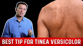 Natural Skin Fungus Tinea Versicolor Home Remedies – Dr Berg [upl. by Margarette]