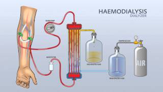 HAEMODIALYSIS DIALYZER [upl. by Olive]