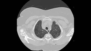 Pulmonary Langerhans cell histiocytosis PLCH on CT [upl. by Yecak549]