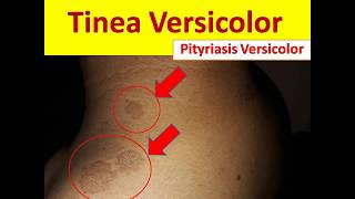 Tinea Versicolor in Young People  Pityriasis Versicolor [upl. by Mctyre919]