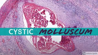 Molluscum Contagiosum cystic 5Minute Pathology Pearls [upl. by Dempster176]