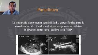 Colecistitis aguda Clínica diagnóstico exámenes complementarios y tratamiento [upl. by Rahas]