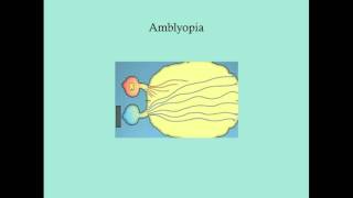 Difference between Myopia Near Sightedness amp Hyperopia FarSightedness [upl. by Noella]