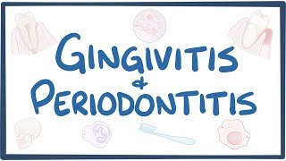 Gingivitis and periodontitis  causes symptoms diagnosis treatment pathology [upl. by Clemente161]