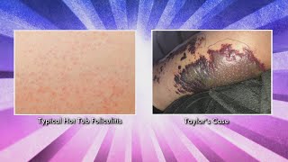 What Puts You at Risk for Hot Tub Folliculitis [upl. by Erual]