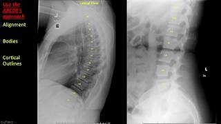 Introduction to Spine Radiographs [upl. by Ynahpets]