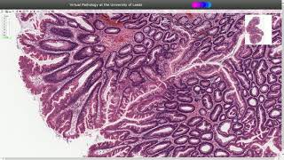 LUNG CANCER  Part 2 Morphology Clinical features [upl. by Monjan173]