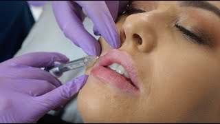 Lip Fillers  what to expect during the procedure  The Laser amp Skin Clinic [upl. by Kat]