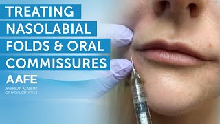 Using Dermal Fillers to Fill and Smooth Smile Lines  AAFE [upl. by Billen]