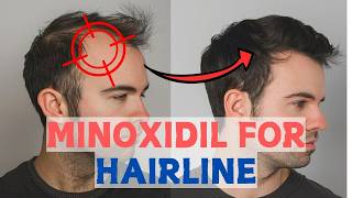 Minoxidil for Frontal Baldness  Restore Your Hairline [upl. by Grewitz884]