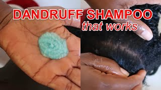 Best SHAMPOO for Dandruff  How to use Nizoral AntiDandruff Shampoo  Discoveringnatural [upl. by Enaitsirhc179]