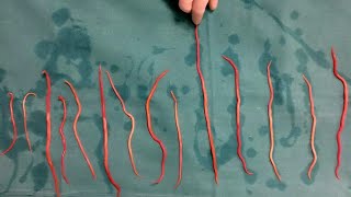 Doctors Remove 14 Roundworms From Woman [upl. by Yalc]