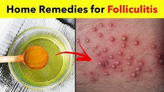 3 Powerful Home Remedies for Folliculitis  Best Folliculitis Treatment at Home [upl. by Schreiber]