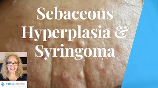 SEBACEOUS HYPERPLASIA VS SYRINGOMA  BEST REMOVAL PROCEDURES [upl. by Elish]