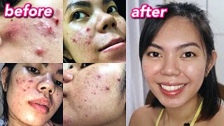 HOW I CLEARED MY ACNE  Cystic Hormonal Acne with PCOS Philippines [upl. by Lyssa]