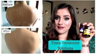 Tinea Versicolor SOLUTIONS TNBeauty94 [upl. by Mcdowell]