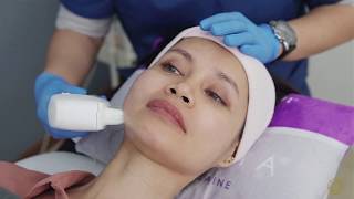 What is HIFU treatment  Instant Facelift without surgery [upl. by Godewyn115]