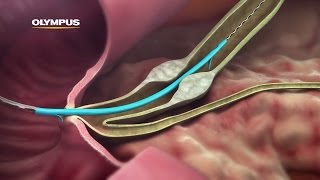 QuickPlaceV Biliary Stent [upl. by Eilrahs]