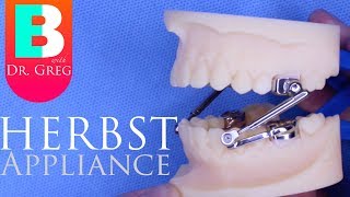 BRACES EXPLAINED Herbst Appliance [upl. by Frantz556]