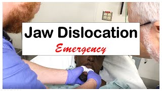 Acute Jaw Dislocation Emergency [upl. by Indihar]