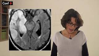 Cas de neurologie méningoencéphalite herpétique [upl. by Loise]