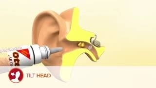 How to use Otex Ear Drops [upl. by Berg]