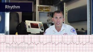 Atrial Fibrillation ECG Rhythm Interpretation [upl. by Hilaria]