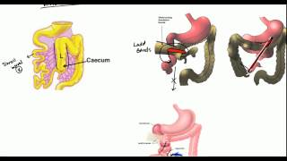 Gut Malrotation Nonrotation and Volvulus for USMLE [upl. by Binette]