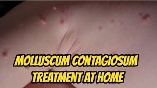 Molluscum contagiosum Treatment At Home [upl. by Nonnaer]