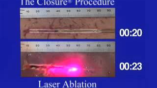 Ablation vs Resection in Liver Cancer [upl. by Ilana]