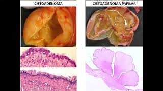 Generalidades de neoplasias I [upl. by Orsola]