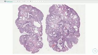 Histopathology ColonTubular adenoma [upl. by Elon638]