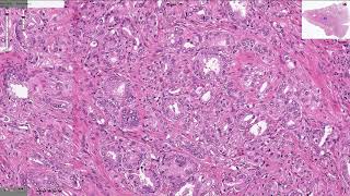 Prostatic Adenocarcinoma  Histopathology [upl. by Irahc]