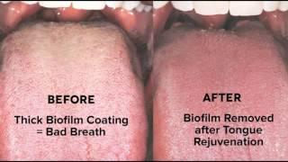 Tongue Rejuvenation  Cure Bad Breath Biofilm amp Halitosis 7035330927 [upl. by Rissa]