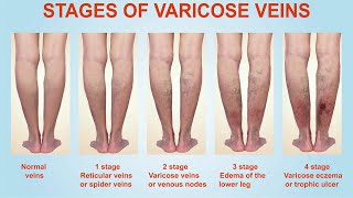 Stages of Varicose Veins [upl. by Publias]