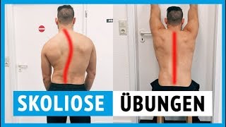 Skoliose Übungen vom Physiotherapeuten für zu Hause [upl. by Arabeila]