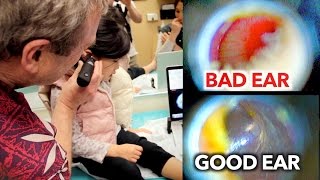 EAR INFECTION vs PERFECT EAR Inside Look  Dr Paul [upl. by Hiltan]