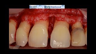 Periodontal Surgery Upper Front Teeth [upl. by Nyliac448]