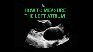 ECHOCARDIOGRAM How to measure the Left Atrium Diameter [upl. by Dorisa]