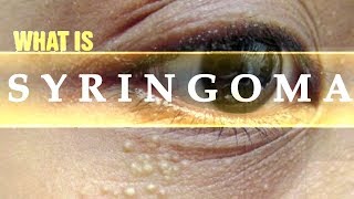 What is Syringoma  Usapang Pangkalusugan [upl. by Tally]