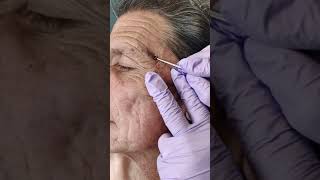 Acne extraction of blackheads and whiteheads popping pimples in Los Angeles [upl. by Ariada]