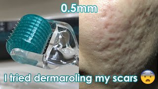 I tried dermarolling my ACNE SCARS  Demo  Review [upl. by Latashia]