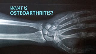 Rheumatoid Arthritis  Treatment  Johns Hopkins [upl. by Rep946]