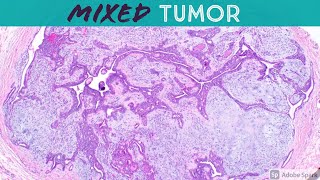 Chondroid Syringoma Mixed Tumor  Like Pleomorphic Adenoma of Skin 5Minute Pathology Pearls [upl. by Oiralednac]